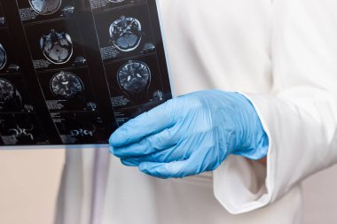 Doktorun elinde bilgisayar tomografisi ile beyin MR taramasının kırpılmış görüntüsü. Beyaz önlüklü kadın doktor. Beyin ve beyin tomografisini inceliyor. El ele tutuşuyor.