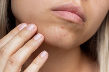 Sivilce sorunu olan genç bir kadının yüzü kesilmiş. Çenesinde sivilceler. Alerji, deri iltihabı, kızarıklık. Sorunlu cilt, özen ve güzellik konsepti. Dermatoloji, kozmetoloji