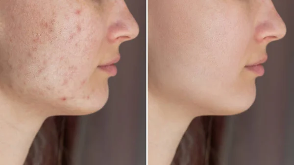 Cropped shot of a young woman's face before and after acne treatment on face. Pimples, red scars, rash on cheeks and chin. Allergies, dermatitis, bad nutrition. Problem skin, care and beauty concept