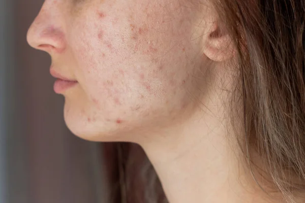 Tiro Cortado Rosto Uma Jovem Perfil Com Problema Acne Espinhas — Fotografia de Stock