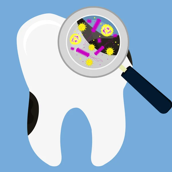 Decadência dentária ampliada — Vetor de Stock