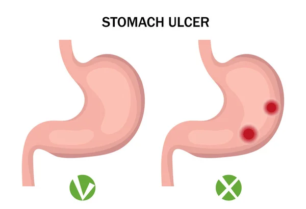 Wrzód żołądka i zdrowa infografika żołądka. Koncepcja medyczna. Ilustracja wektora — Wektor stockowy