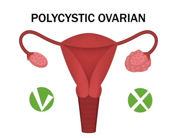 Maladie des ovaires polykystiques et ovaire sain. infographie médicale. Illustration vectorielle — Image vectorielle
