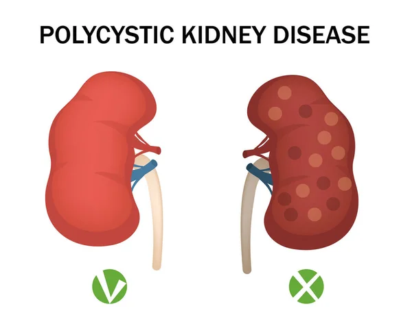 Polyzystische Nierenerkrankung und gesunde Niere. Medizinische Infografiken. Vektorillustration — Stockvektor