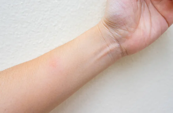 ulticaria from insect bite at left arm. skin lesion concept
