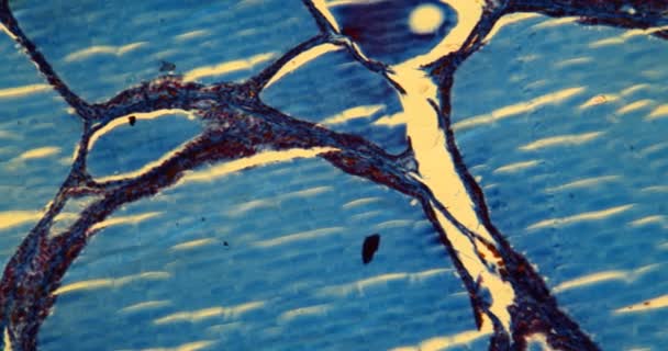 顕微鏡下のゴイターコロイドゴイター組織100X — ストック動画