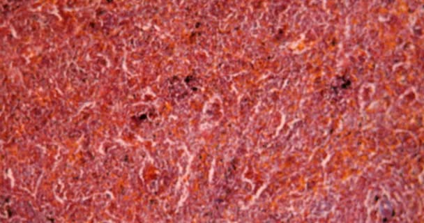 Малярія Маланемія Селезінки Хворих Тканин Під Мікроскопом 100X — стокове відео