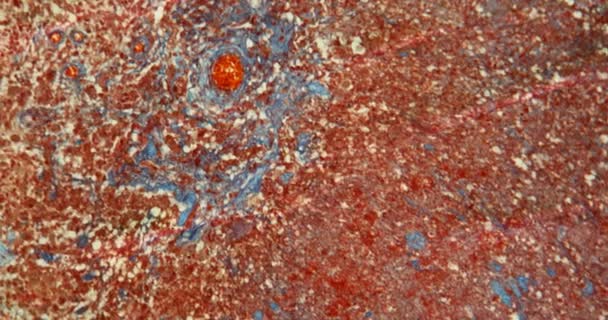 Melanosarcoma Del Tejido Cutáneo Bajo Microscopio 100X — Vídeo de stock