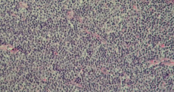 显微镜下恶性淋巴瘤组织200X — 图库视频影像