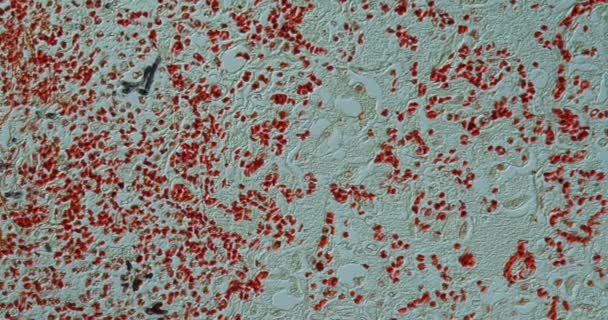 200X显微镜下肺中的Aids念珠菌 — 图库视频影像