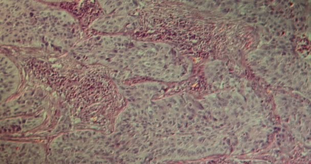 Plaveiselcelcarcinoom Longweefsel Onder Microscoop 100X — Stockvideo