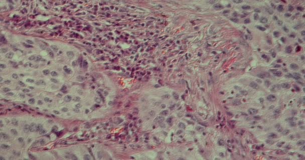 Carcinoma Células Escamosas Tejido Pulmonar Bajo Microscopio 200X — Vídeos de Stock