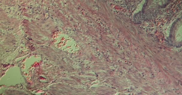 Φυματίωση Αδένωμα Του Παχέος Εντέρου Ιστού Κάτω Από Μικροσκόπιο 100X — Αρχείο Βίντεο