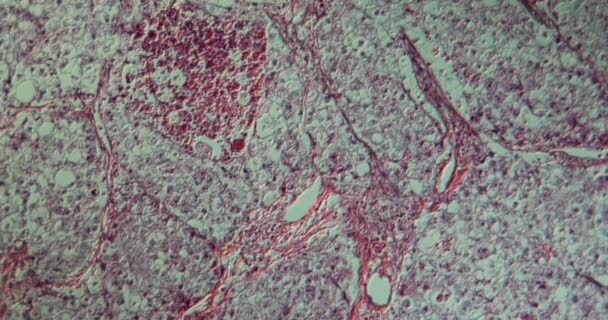 Tejido Carcinoma Ovario Bajo Microscopio 100X — Vídeo de stock