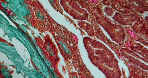 Tessuto Del Carcinoma Del Retto Microscopio 100X — Video Stock