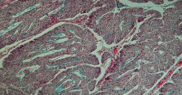 Carcinoma Geleia Tecido Intestino Grosso Sob Microscópio 100X — Vídeo de Stock