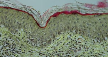 Mikroskop altında cilt enfeksiyonu Herpes zoster dokusu 200x