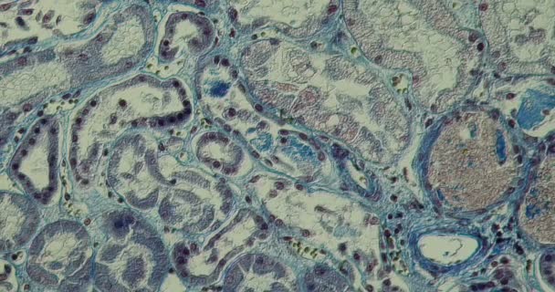 Deposição Fibrina Tecido Renal Sob Microscópio 200X — Vídeo de Stock