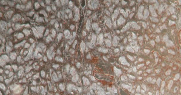 Corazón Escombros Amiloides Tejido Darkfield Bajo Microscopio 100X — Vídeos de Stock