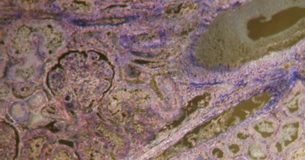 Fibrynowe Osadzanie Nerki Tkance Darkfield Pod Mikroskopem 100X — Wideo stockowe