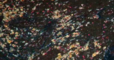 Darkfield dokusunda yabancı cisim granülomu mikroskop altında 200x