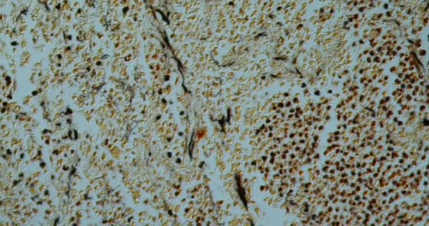 Lungeninfektion Mit Norcardia Gewebe Unter Dem Mikroskop 200X — Stockvideo