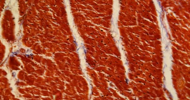 Хронічна Запальна Тканина Серця Під Мікроскопом 100Х — стокове відео