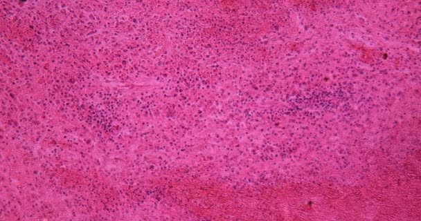 Sarcoma Glándula Linfática Tejido Enfermo Bajo Microscopio 100X — Vídeo de stock