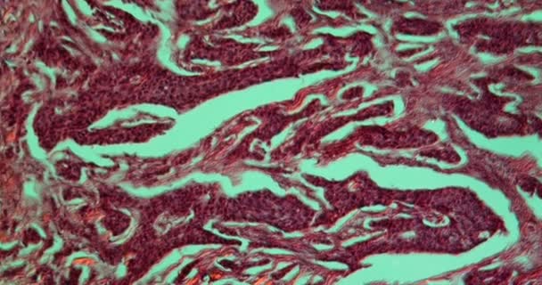 Ιστός Του Καρκίνου Του Μαστού Κάτω Από Μικροσκόπιο 100X — Αρχείο Βίντεο