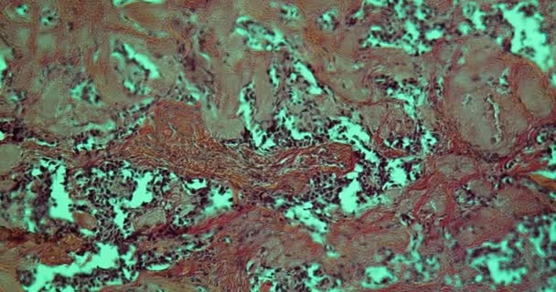 Thyroid Carcinoma Tissue Microscope 100X — Stock Video