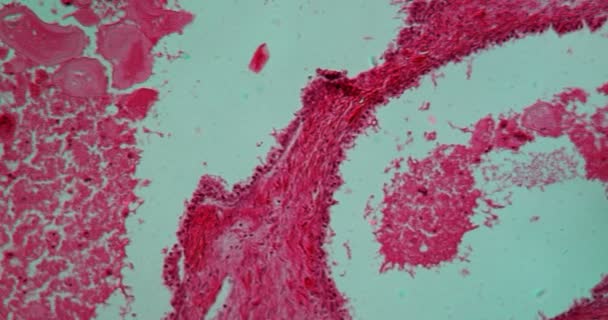 100X显微镜下前列腺增殖性病变组织 — 图库视频影像