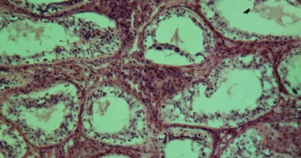 Testikel Inguinal Berpenyakit Jaringan Bawah Mikroskop 100X — Stok Video