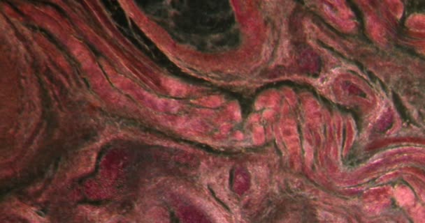 Amygdalite Dans Tissu Darkfield Microscope 100X — Video
