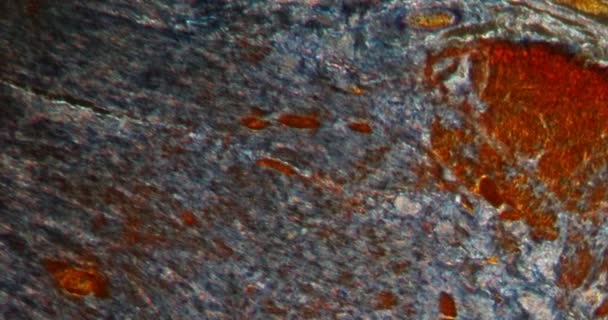 Эзофаг Воспаление Ткани Даркфилда Микроскопом 100X — стоковое видео