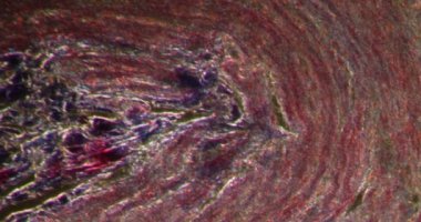 Darkfield dokusunda eklenti iltihabı mikroskop altında 100 x