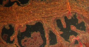 Darkfield dokusundaki prostat hipertrofisi mikroskop altında 100 kat