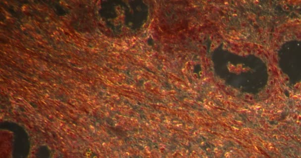 Hypertrophie Prostate Dans Les Tissus Darkfield Microscope 200X — Video