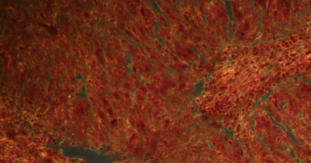 Καρκίνωμα Της Μήτρας Στο Darkfield Ιστό Κάτω Από Μικροσκόπιο 200X — Αρχείο Βίντεο