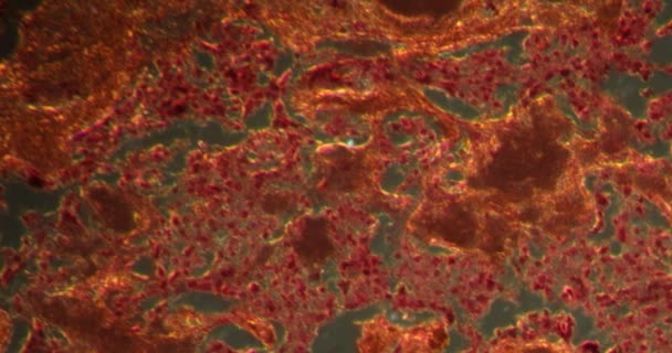 Carcinoma Ghiandola Tiroidea Nel Tessuto Darkfield Microscopio 100X — Video Stock