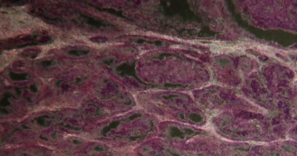 Matastases Liver Darkfield Tissue Microscope 100X — Stock Video