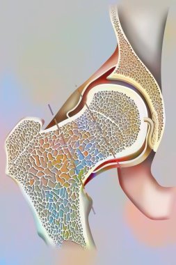 Femoral boyun kemiğinde kemik erimesi ve kırık bölgelerinde konum, insan anatomisinin tıbbi çizimi.
