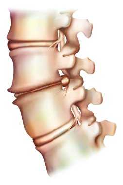 Bel omurunda spondiyloartrosis (lumbar osteoartrit), disk osteoartrit, bel fıtığı diski ve interaphyseal osteoarthritis. Spondiloartrosis, omurgada iltihaplı olmayan bir dejenerasyon (osteoartrit).. 