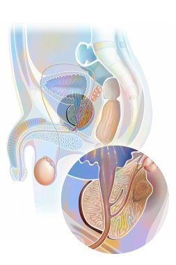 Prostat kanseri (genellikle adenokarsinom), beyaz arkaplanda tıbbi çizimler