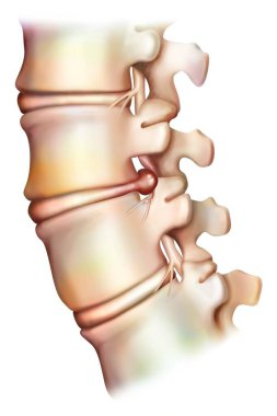 Disk fıtığı. Fıtıklaşmış disk omurgalar arası diskin bir çıkıntısıdır ve omuriliğe baskı yapabilir. Genellikle bel omurunun seviyesinde yer almaktadır..