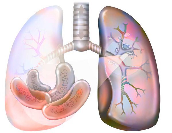 Легочный туберкулез. Бациллы Коха колонизируют легкие и развиваются, разрушая ткани, формируя очаги (caseum). Эти очаги кальцифицируются, образуя пещеры, в которых размножаются бактерии, и которые сохраняются после восстановления.