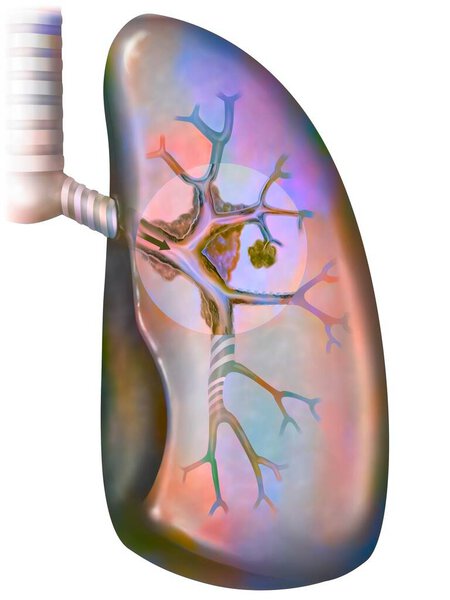 Рак легких курильщика (с наличием депозитов смолы в бронхах).