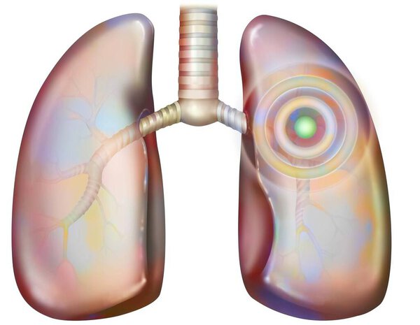Иллюстрация легочных патологий (пневмопатий): бронхит, пневмония, эмболия, рак.