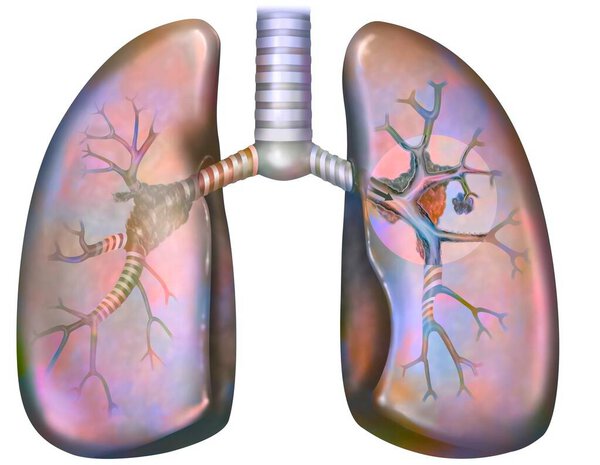 Рак легких курильщика (с наличием депозитов смолы в бронхах).