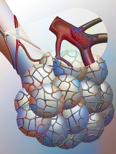 Эмболия легких. Артериола, снабжающая конечную бронхиолу, блокируется тромбом, вызывающим легочную эмболию. Если этот феномен повторяется, этот тип эмболии может быть смертельным..