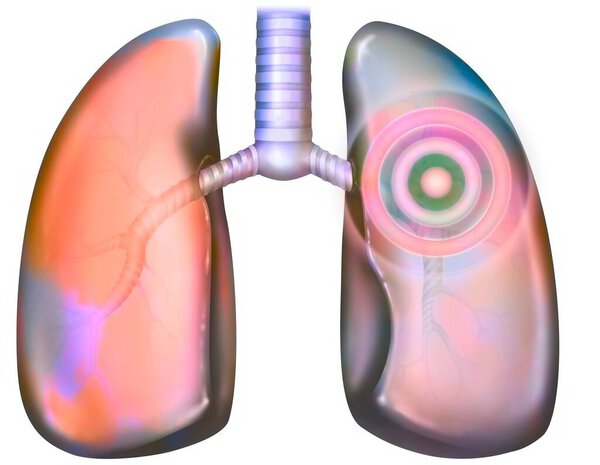 Иллюстрация легочных патологий (пневмопатий): бронхит, пневмония, эмболия, рак.